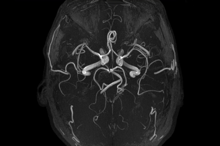 Проведение обследования сосудов головного мозга