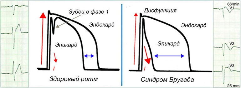 Провоцирующие развитие синдрома ранней реполяризации желудочков