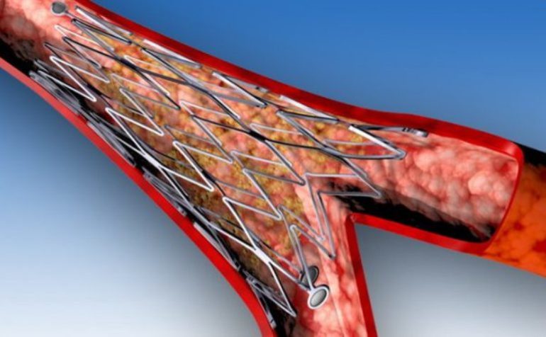 Как проводится операция стентирование коронарных артерий