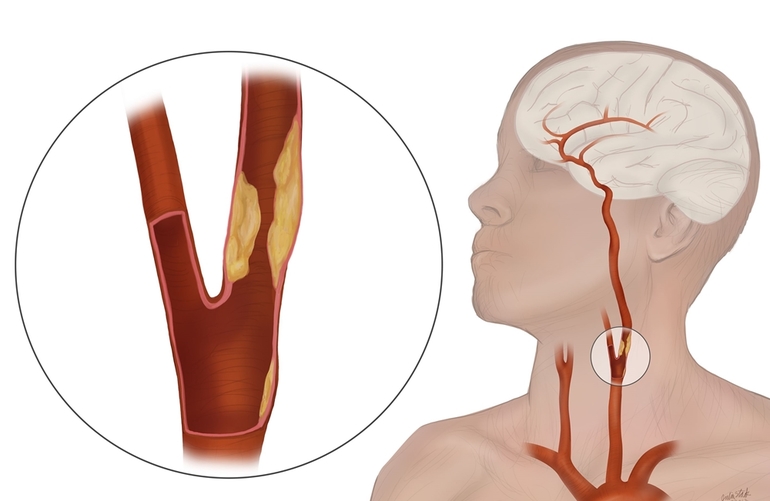 Проявление патологий сонной артерии