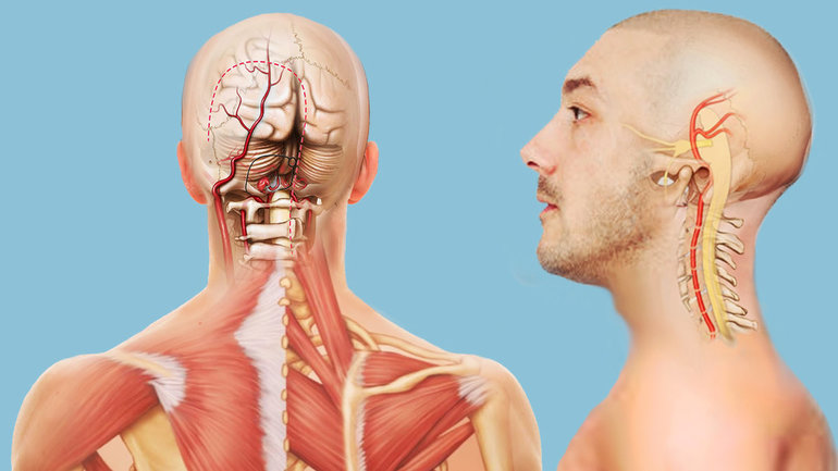 Как проявляется синдром позвоночной артерии