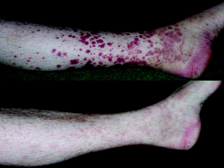 Как проявляется заболевание васкулит