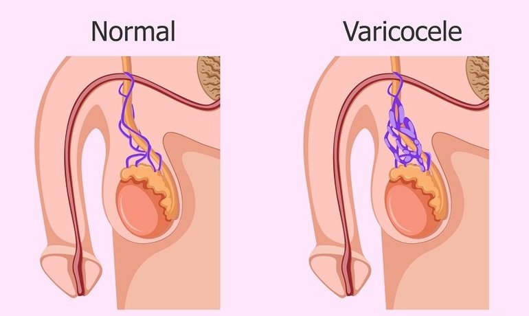 Как проявляется заболевание варикоцеле
