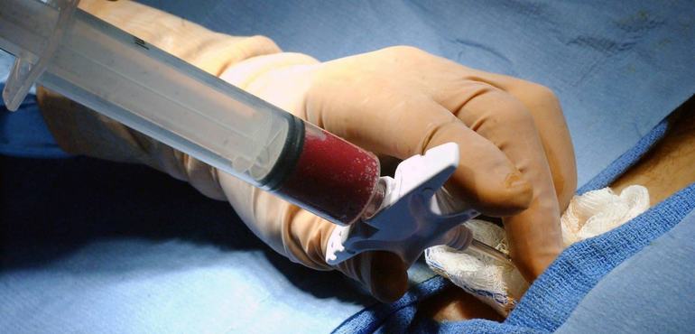 Пункция тканей костного мозга