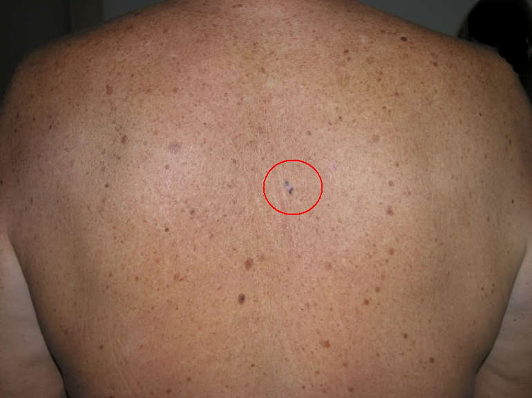 Рак крови, симптомы у взрослых