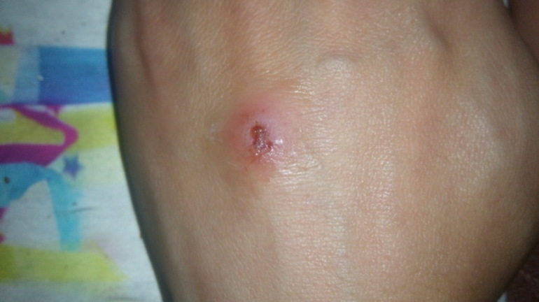 Рак крови стадии