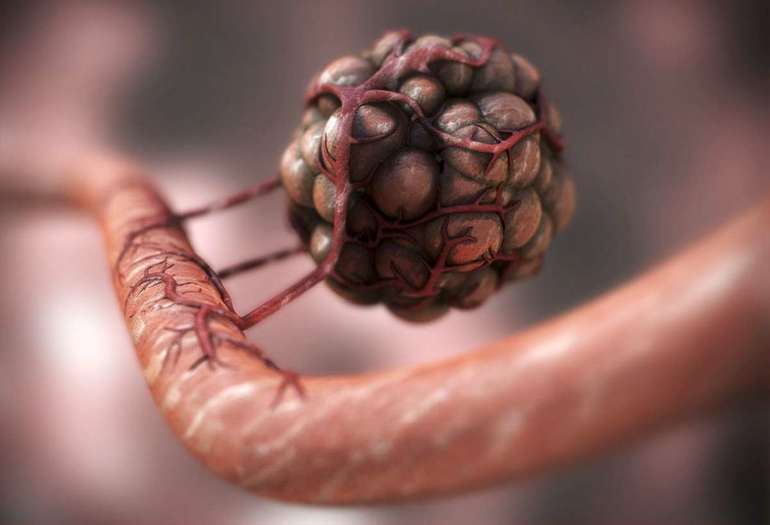 Раковая опухоль