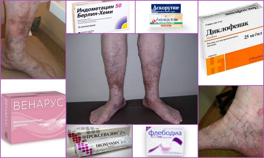 венозная недостаточность лекарства