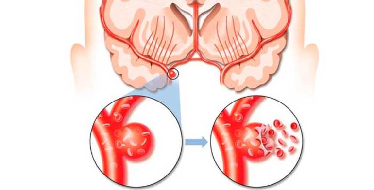 Разновидности аневризмы сосудов головного мозга