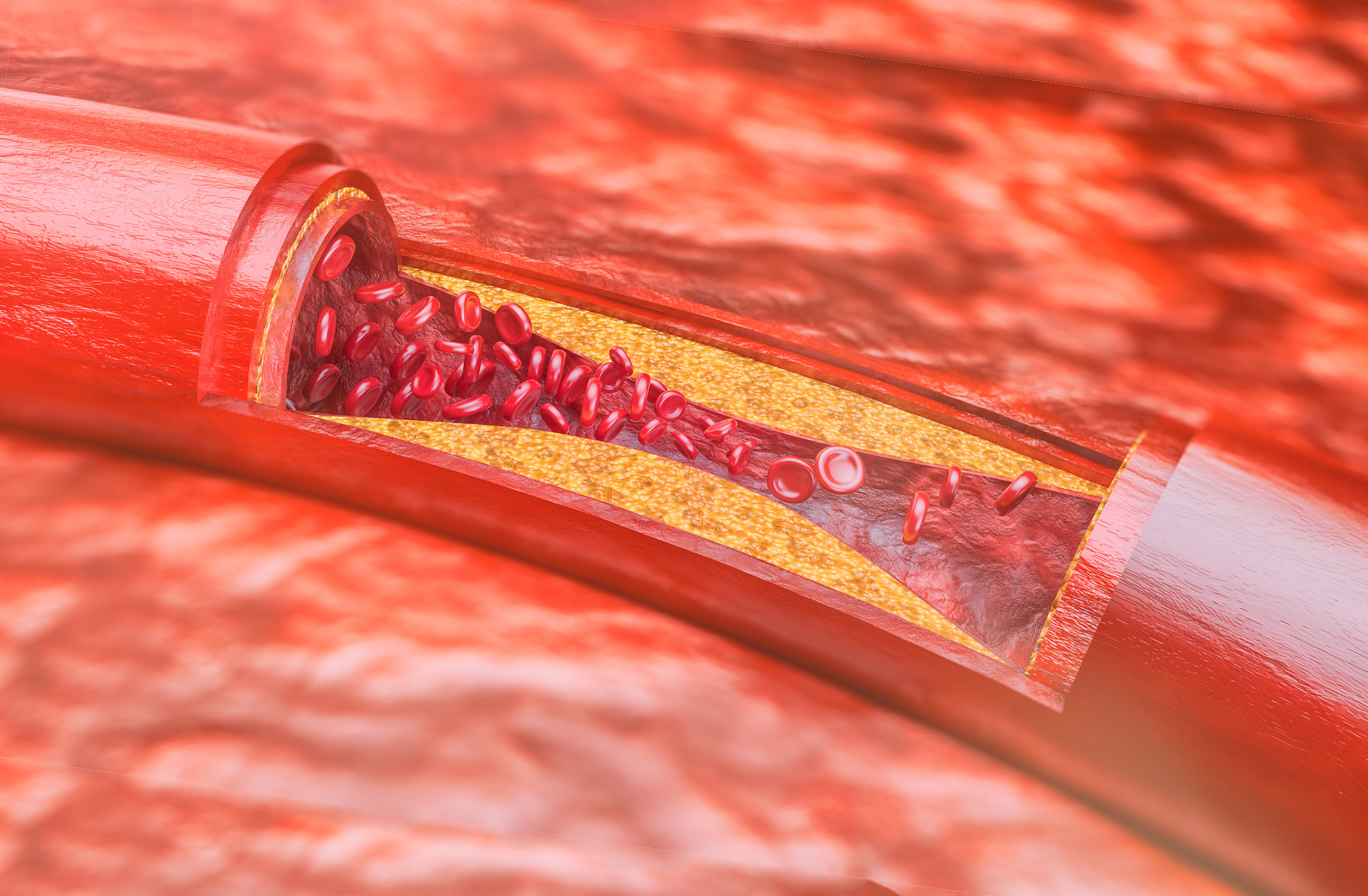 Атеросклероз