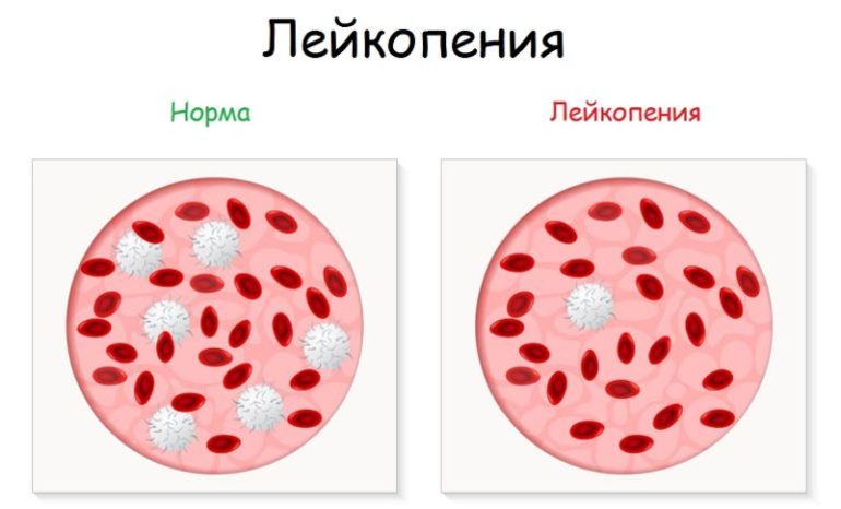Развитие лейкопении