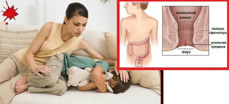 Ректальное кровотечение