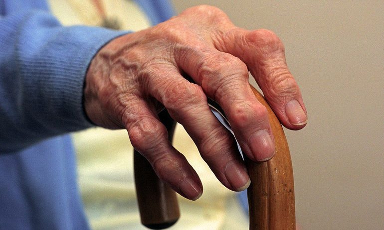 Ревматоидный артрит