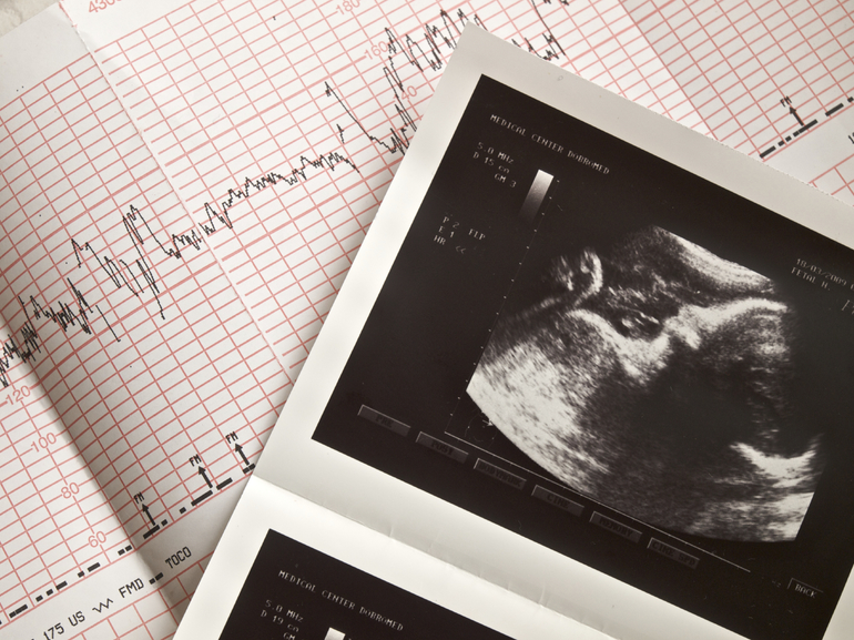 Результат ктг