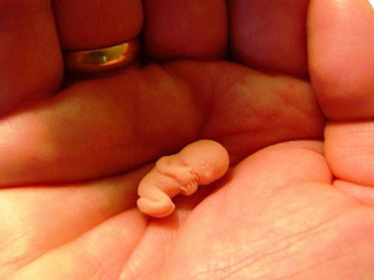 Резус-конфликт и его предпосылки