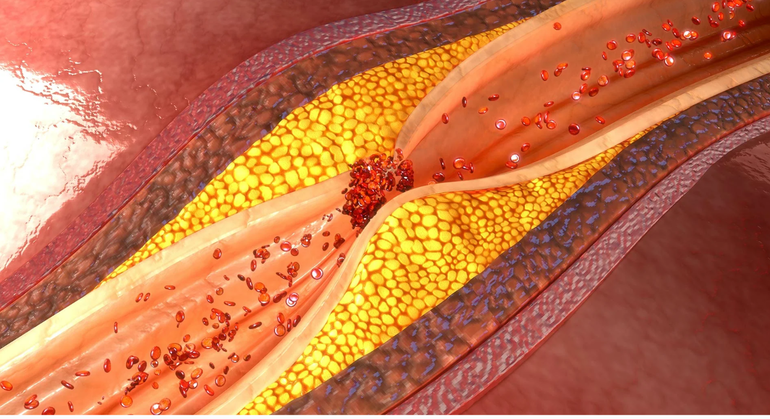 Рост атеросклеротических бляшек,