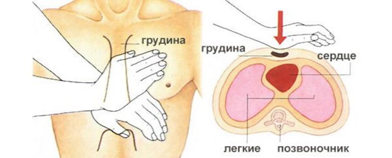 Как сделать прекардиальный удар