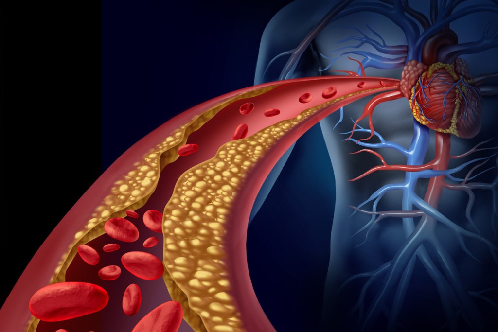 Атеросклероз