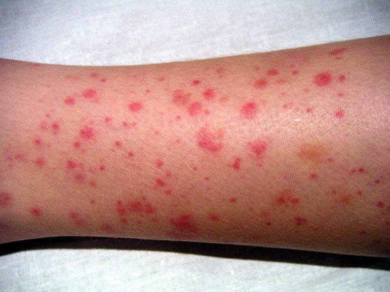 Симптоматика заболевания