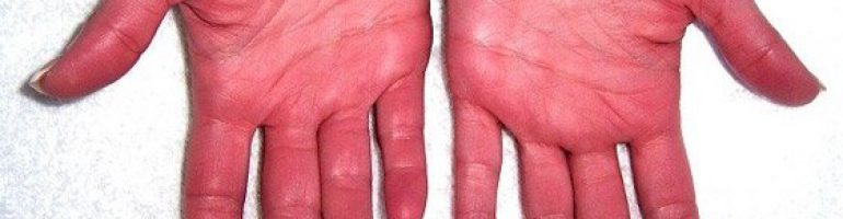 Симптомы полицитемии