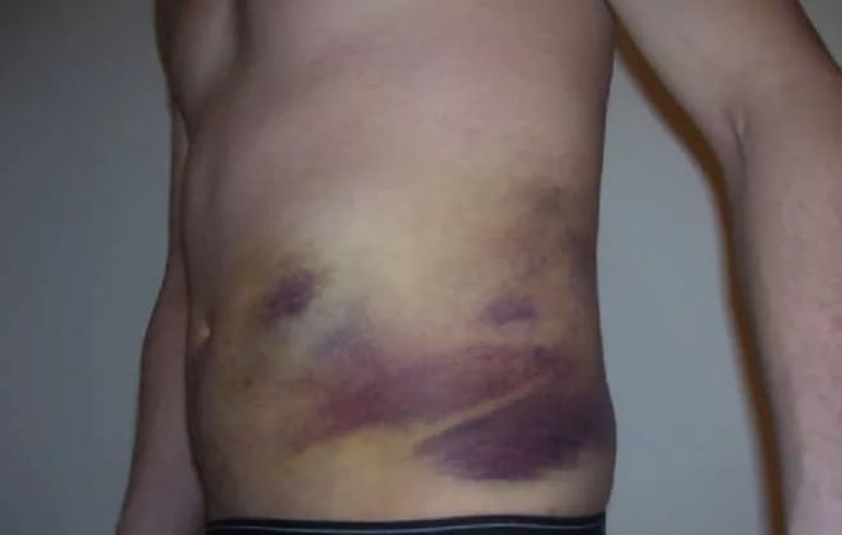 симптомы внутреннего кровотечения в брюшную полость