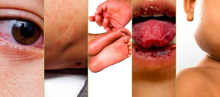 Симптомы заболевания васкулит