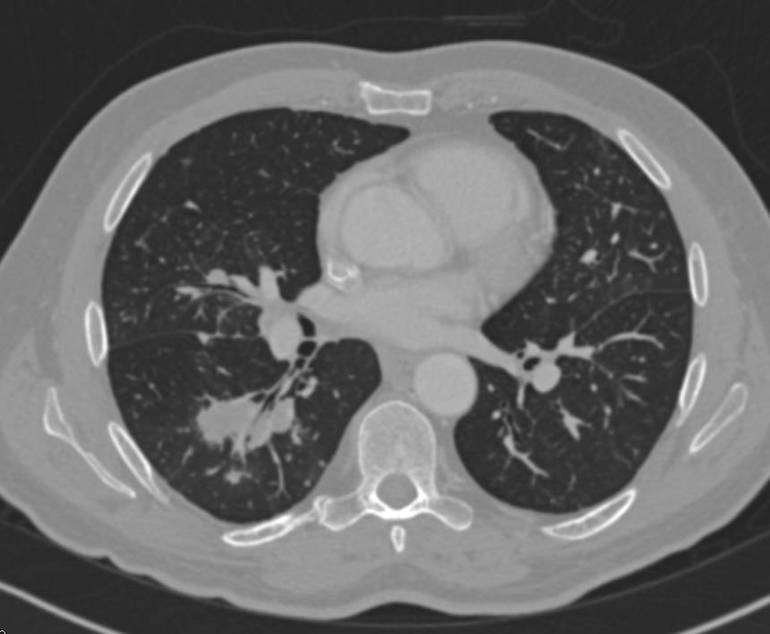 синдром вегенера