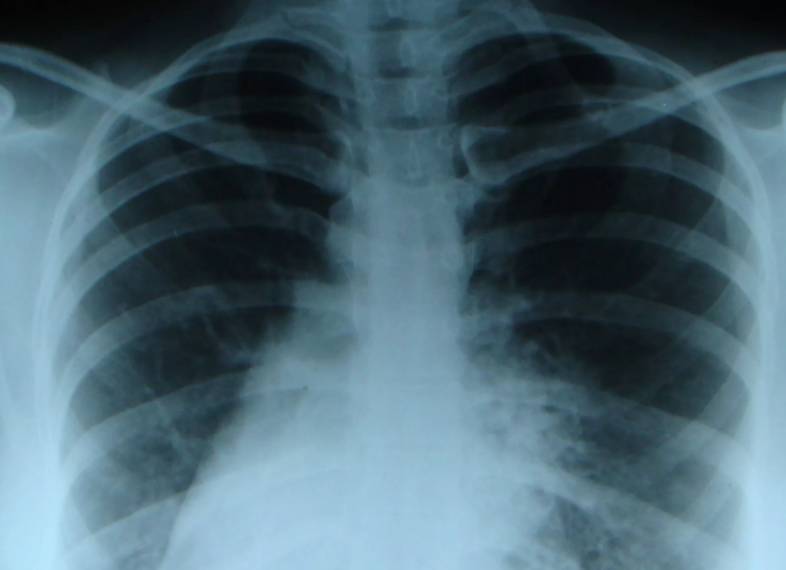 Синдромом Картагенера