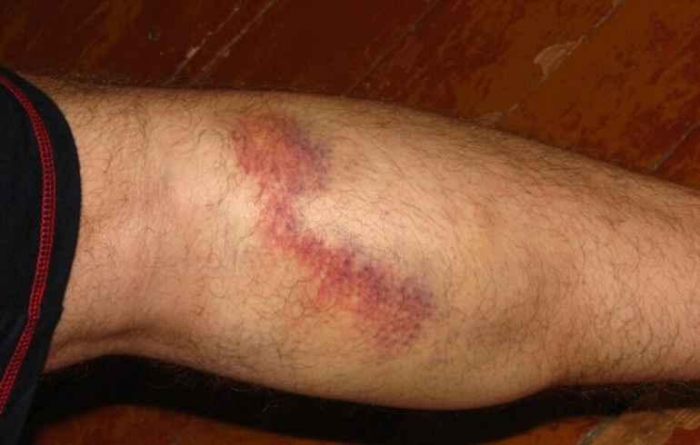 Синяки на теле разного размера