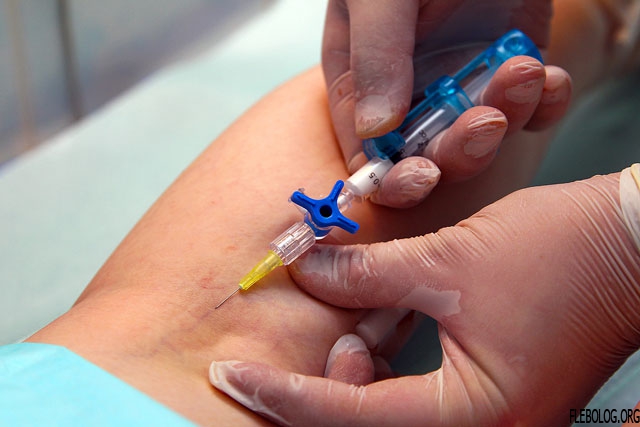 Склеротерапия сосудов