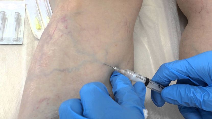 склеротерапия