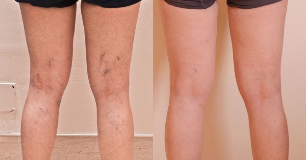 sklerozirovanie-sosudov-nog