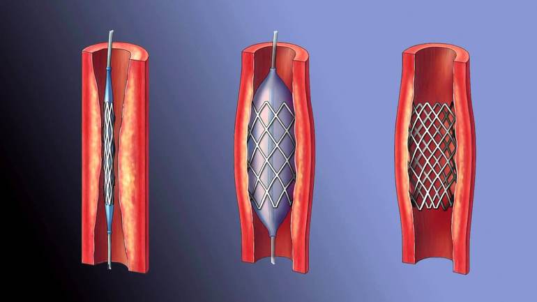 Сколько живут после операции шунтирование