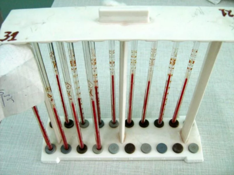 Скорость оседания эритроцитов норма у женщин