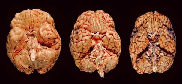 Признаки сосудистой энцефалопатии головного мозга