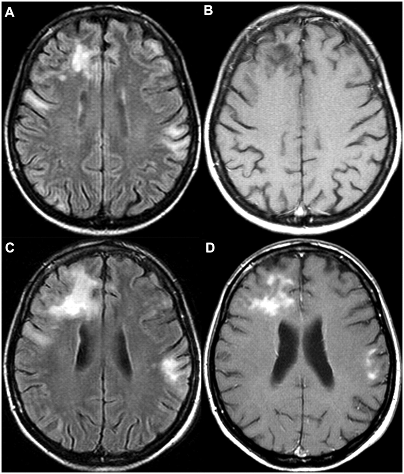 сосудистая энцефалопатия на МРТ