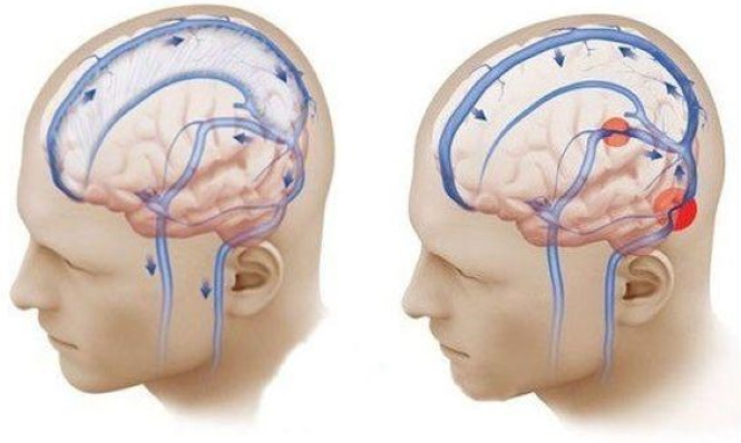 sosudistyj kriz mozga