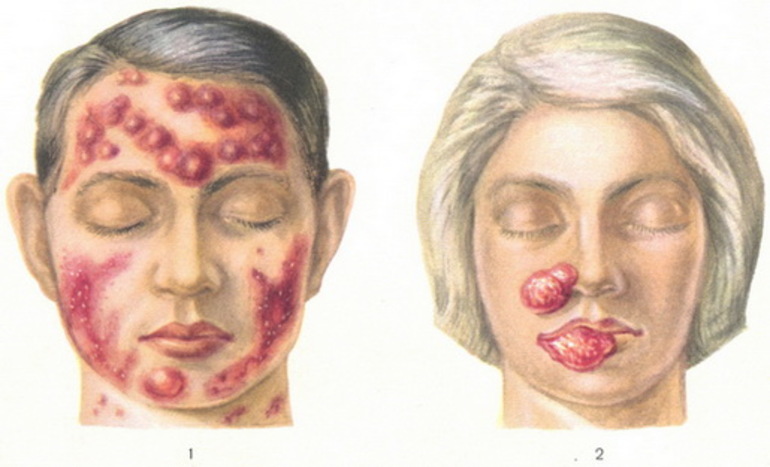 Стадии развития лейкемии