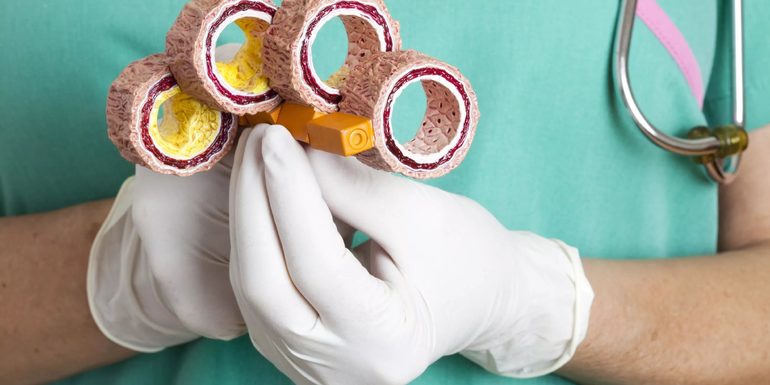 Стадии заболевания