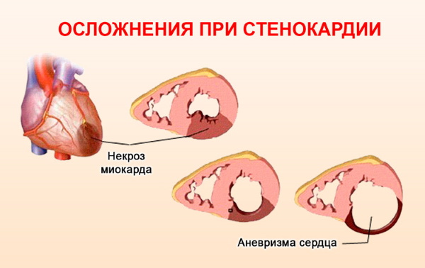stenokardiya oslozhnenija
