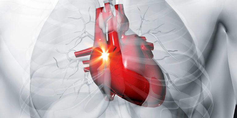 Стенокардия у человека