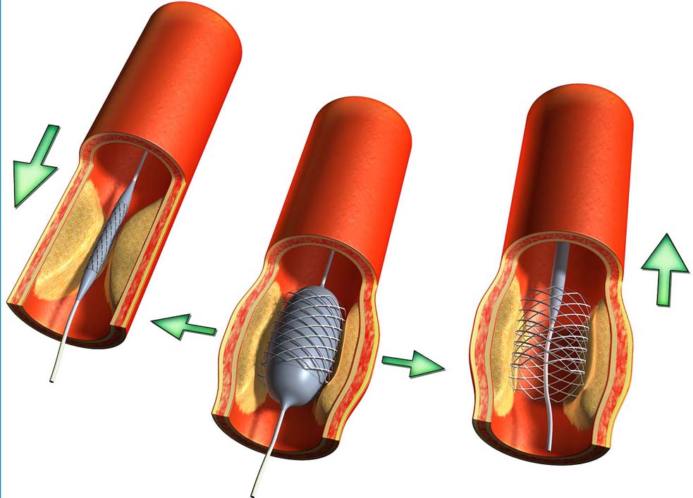 стенты для коронарных сосудов