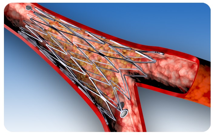 стенты для коронарных сосудов