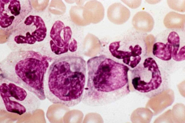 Степени тяжести нейтрофилии