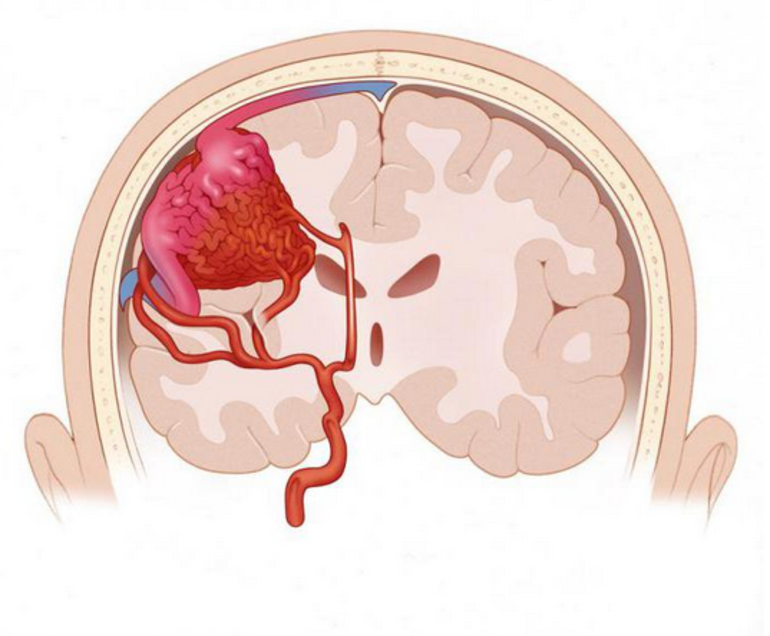 Субарахноидальное кровоизлияние