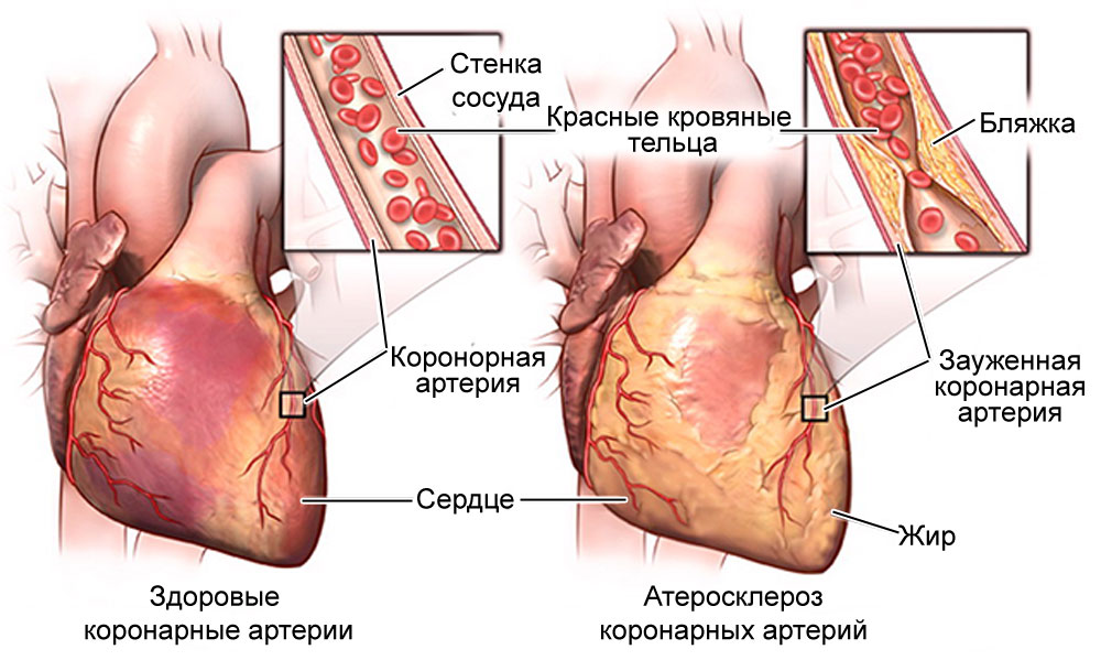 жжение в области сердца
