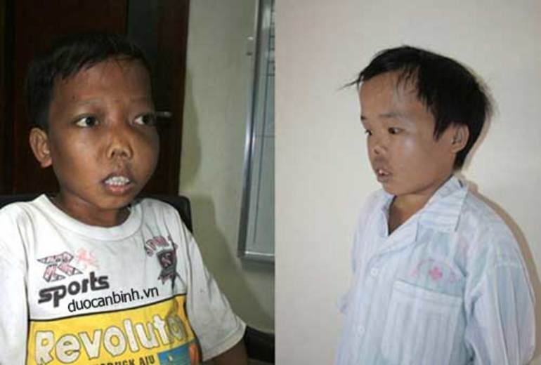 Талассемия симптомы