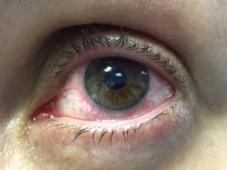 Течение увеита