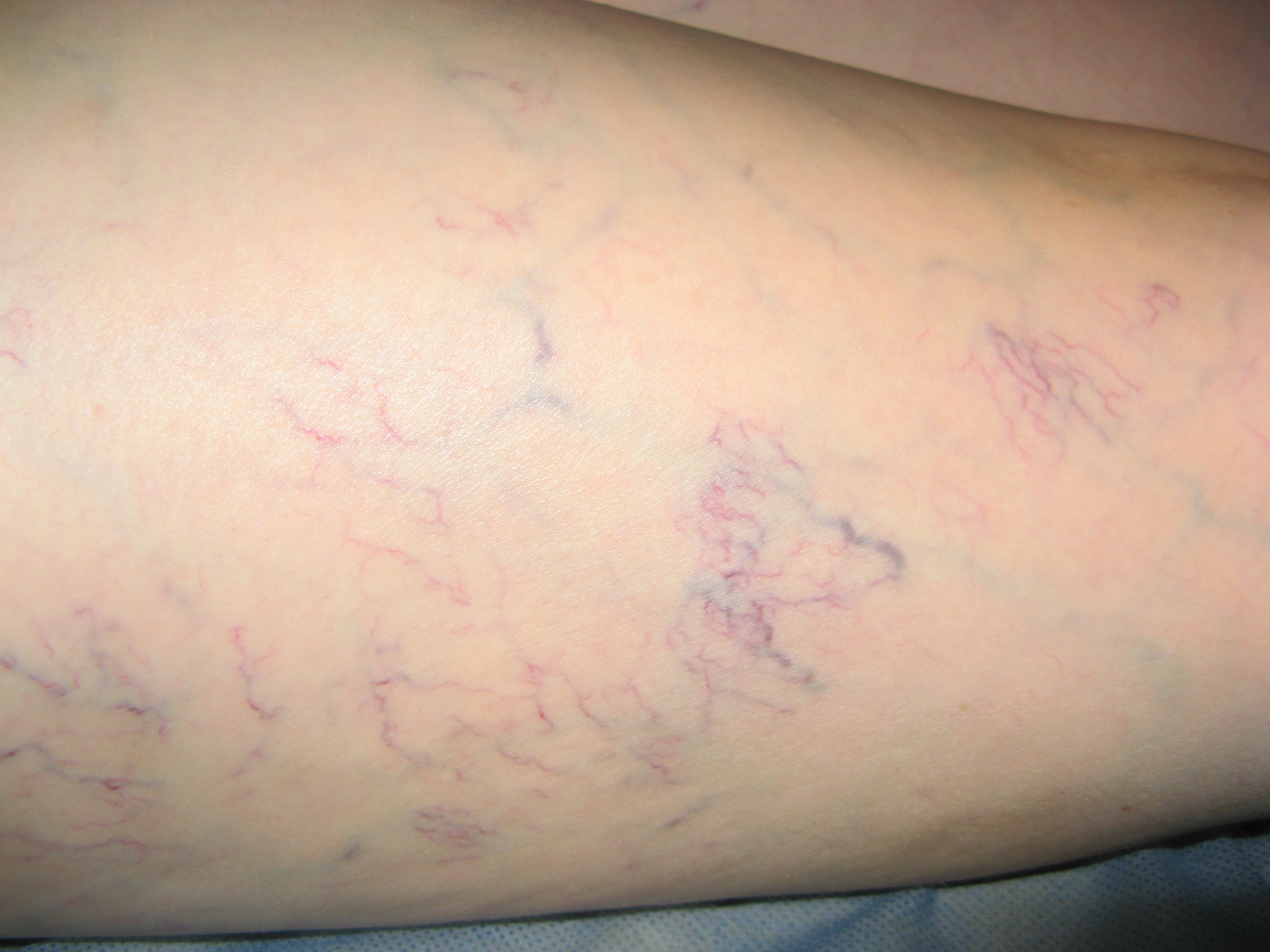 Телеангиэктазия