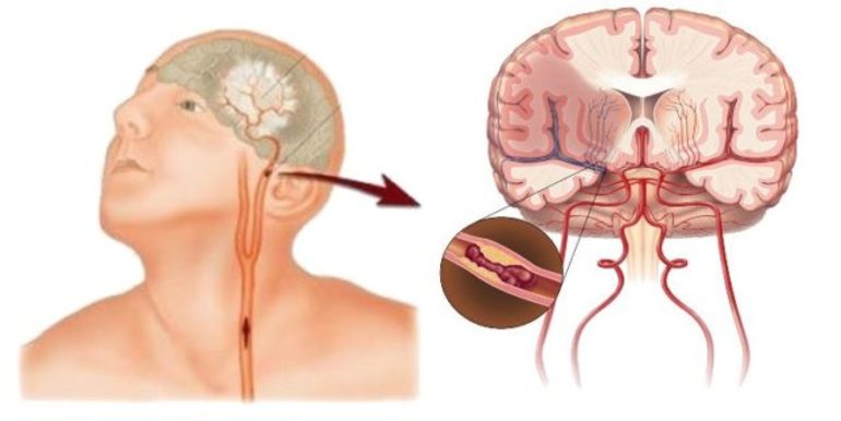 Транзиторная ишемическая атака лечение